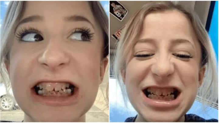 Una chica nació con los dientes más raros del mundo